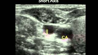 Video procedurale Guida con ecografia per laccesso venoso centrale parte 2 [upl. by Ettennan]