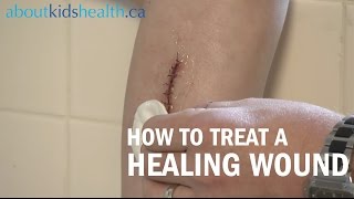 How to care for a healing wound  AboutKidsHealth at The Hospital for Sick Children [upl. by Tivad594]