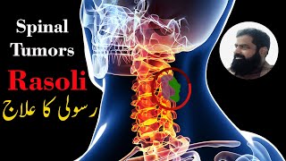 Spinal Cord Tumor Treatment in Urdu Hindi  ट्यूमर का इलाज  رسولی کا علاج [upl. by Oirevas119]