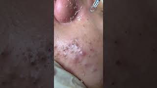 Very harmful this is your acne [upl. by Fiorenze]