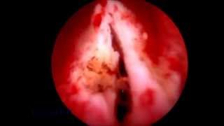 Utricular cyst deroofing [upl. by Damiano502]