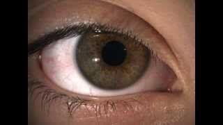 Hippus pupil fluctuation in a normal healthy eye [upl. by Ienttirb3]