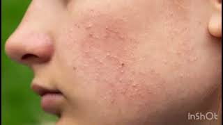 About Fungal acne skincare fungalacne comedogenicacne purging [upl. by Caralie]