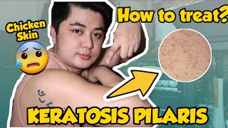 HOW TO TREAT KERATOSIS PILARIS  Chicken Skin  By Mark de Leon [upl. by Gemoets]