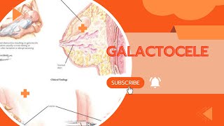 GALACTOCELECAUSES SYMPTOMS AND TREATMENTA MUST WATCH [upl. by Elcarim]