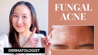 Dermatologists Guide to FUNGAL ACNE  What is it amp Treatments [upl. by Elleon]