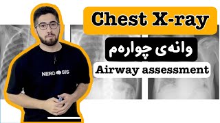 4 Chest Xray airway assessment [upl. by Goodrow]