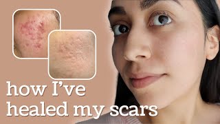 Healing Hyperpigmentation  Deep Pitted Acne Scars this is what I’ve done [upl. by Buffy]