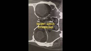 SILENT SINUS SYNDROME nose SILENT SINUS SYNDROME [upl. by Il]