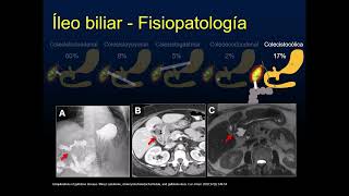 Radiología en 5 minutos Íleo biliar [upl. by Duleba]