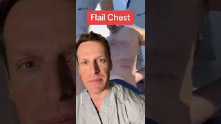 Flail chest is a potentially serious injury A flail chest are ribs broken in two or more places [upl. by Adnolat825]