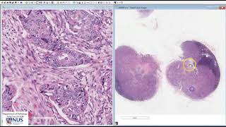 Breast Invasive carcinoma NST with lymph node metastases Microscopy Talking slide [upl. by Nova]