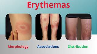 Erythemas Uncovered Insights into Morphology Associations and Distribution [upl. by Esorylime261]