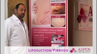 Liposuction Contour Irregularity  Stubborn Lipo Lumps and Bumps Treatment [upl. by Eentrok]