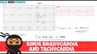 Rate and Rhythm  Sinus Bradycardia and Sinus Tachycardia [upl. by Dloreg]