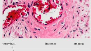 MedDef29 Thrombus vs Embolus [upl. by Carnay]