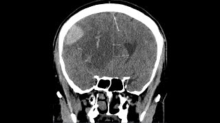 Brain herniation  subphalcine  due to intracranial haemorrhage CT findings [upl. by Eaver]