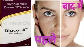 Pimples Acne और Whitening क्रीमGlyco A 12glyco A 12 creamglyco 6 [upl. by Estrella]