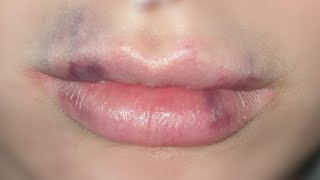 how to get rid of bruising after lip fillers tutorial [upl. by Sharona227]