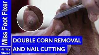 SATISFYING DEEP CORN EXTRACTION REMOVAL AND NAIL CUTTING BY MISS FOOT FIXER [upl. by Hagood]