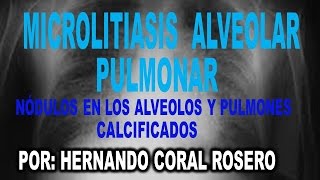 MICROLITIASIS ALVEOLAR PULMONAR  NÓDULOS EN LOS ALVEOLOS Y PULMONES CALCIFICADOS [upl. by Anaihsat196]