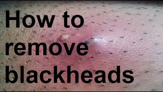 How to remove blackheads [upl. by Tilla528]