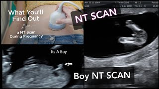 NT SCAN  How to Find Babys Gender In NT SCAN  NT scan report pregnancy ntscanreport ntscan [upl. by Alper904]