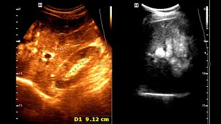 Sonographic Features of Gastric carcinoma  Limitations of Ultrasound  Complementary Imaging [upl. by Scrivens]