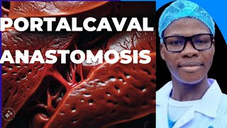 Portalcaval anastomosis Indication liver physiology and complications of the procedure [upl. by Weight340]