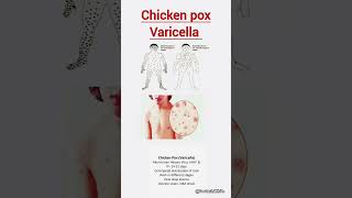 Chicken pox varicella  viralshorts chickenpox varicella [upl. by Olecram]