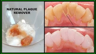 HOW TO REMOVE DENTAL PLAQUE  DISCOLORATION FROM TEETH USING NATURAL HOME REMEDY Khichi Beauty [upl. by Rebmat]