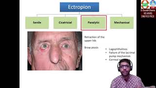 Ectropion Basics to Surgical aspects [upl. by Jobie]