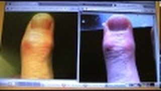 19  Healing deforming rheumatism  techniques for straightening the finger  follow up video 8 [upl. by Itida]