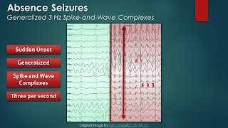 Absence Seizures EEG Findings [upl. by Lohcin]