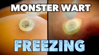 2 MONSTER WARTS vs 1 MOTHER amp SON Frozen With Liquid Nitrogen  Dr Paul [upl. by Aden]