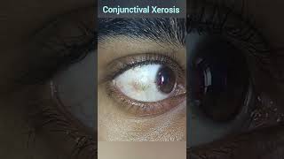 Xerophthalmia  Conjunctival Xerosis  Vitamin A Deficiencies [upl. by Ketchum]