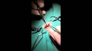 Eyelid margin closure with Figure 8 suture technique [upl. by Etnomaj]