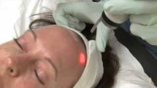 Active FX Fractional CO2 Laser Resurfacing  Part I  Austin Dermatologist [upl. by Acilgna266]