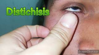 Distichiasis lower eyelid [upl. by Whiney453]