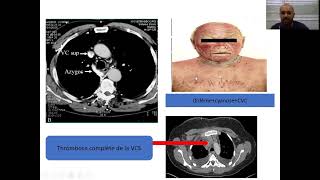 11Cancer bronchique partie 1  Pneumo [upl. by Entruoc]