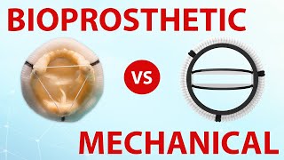 Mechanical or Bioprosthetic Heart Valves Which Is Best For You [upl. by Almat]