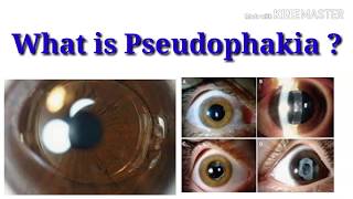 What is pseudophakia  sign  Intraocular lens  sharp vision [upl. by Locke]