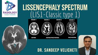 Lissencephaly SpectrumClassic Type1Sandeep VelichetIunderstanding lissencephaly microscopic level [upl. by Orutra]