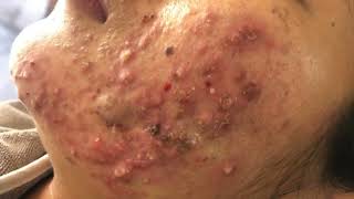 Whiteheads on foreheads  Giant Acne amp Pimple Treatment  Blackhead Removal  Remove Blackheads [upl. by Nairred]