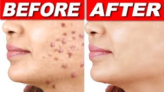 रातों रात पिंपल्स हटाने का रामबाण नुस्खा Remove pimples permanentlybest acne treatment at home [upl. by Llerrej893]