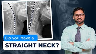 Understanding Loss of Cervical Lordosis Straight Neck Causes and Symptoms with Dr Anuj Bhide [upl. by Ardnazil]