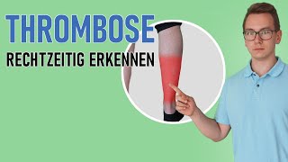 Thrombose Habe ich eine Thrombose Symptome und Anzeichen erkennen [upl. by Otrevlig842]