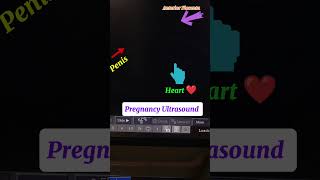 Boy Baby Penis Anterior Placenta Heartbeat  Pregnancy Ultrasound boybaby [upl. by Adiasteb]