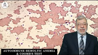 Episode 12  Auto Immune Hemolytic Anaemia AIHA amp COOMBs Test [upl. by Mandych883]