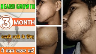 BEARD GROWTH □ अच्छी दाढ़ी के लिए ये काम जरुर करें  grow beard in three months  From minoxidil [upl. by Korman]